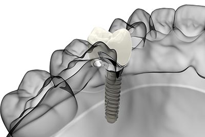 Implantate und Knochenaufbau